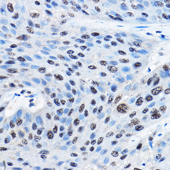 Immunohistochemistry of paraffin-embedded human esophageal cancer using NUDT21 Rabbit pAb  at dilution of 1:100 