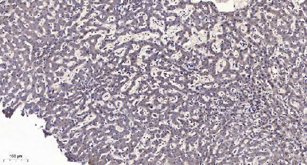 Immunohistochemical analysis of paraffin-embedded human liver cancer