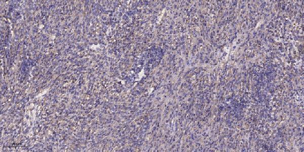 Immunohistochemical analysis of paraffin-embedded human Colon cancer