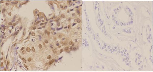 Immunohistochemistry (IHC) analyzes of PSMD6 pAb in paraffin-embedded human breast carcinoma tissue at 1:50