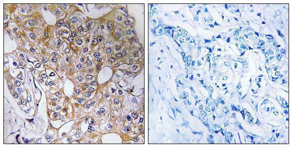 Immunohistochemistry analysis of paraffin-embedded human breast carcinoma tissue, using CCT6A Antibody