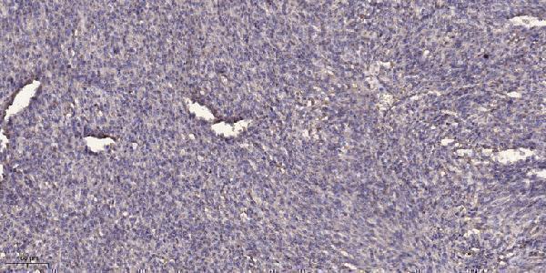 Immunohistochemical analysis of paraffin-embedded human Colon cancer