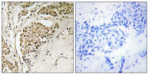 Immunohistochemistry analysis of paraffin-embedded human breast carcinoma tissue, using NOM1 Antibody