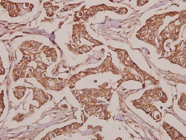 Immunohistochemistry (IHC) analyzes of SLC25A6 (R155) pAb in paraffin-embedded human breast carcinoma tissue at 1:50