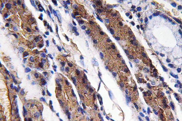 Immunohistochemistry analysis of Pepsin A antibody in paraffin-embedded human lung carcinoma tissue