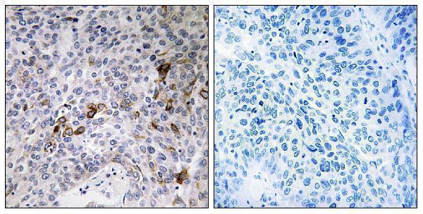 Immunohistochemistry analysis of paraffin-embedded human lung carcinoma tissue, using RAB11FIP3 Antibody