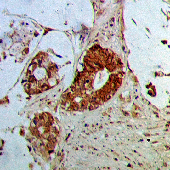 Immunohistochemistry (IHC) analyzes of SCFD1 polyclonal antibody in paraffin-embedded human colorectal cancer tissue at 1:50