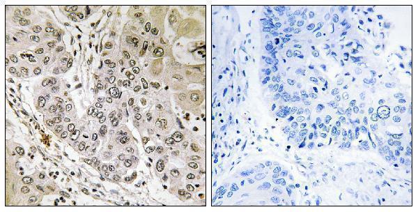 Immunohistochemistry analysis of paraffin-embedded human lung carcinoma tissue, using STK36 Antibody