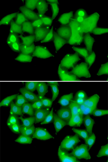 Immunohistochemistry of paraffin-embedded human lung cancer using UBASH3B Rabbit pAb  at dilution of 1:200 