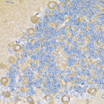 Immunohistochemistry of paraffin-embedded human liver cancer using COX6A1 antibody  at dilution of 1:100 