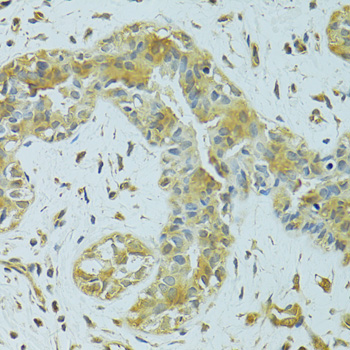 Immunohistochemistry of paraffin-embedded human breast cancer using MTCH1 antibody  at dilution of 1:100 
