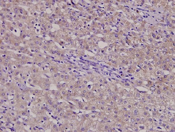 Immunohistochemistry (IHC) analyzes of β-1,4-Gal-T3 (F304) pAb in paraffin-embedded liver cancer tissue at 1:100