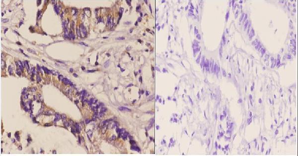 Immunohistochemistry (IHC) analyzes of DGK-δ (S66) pAb in paraffin-embedded human Rectum carcinoma tissue at 1:50