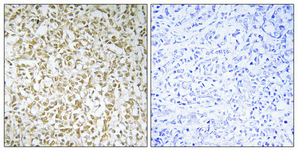 Immunohistochemical analysis of paraffin-embedded Human breast cancer