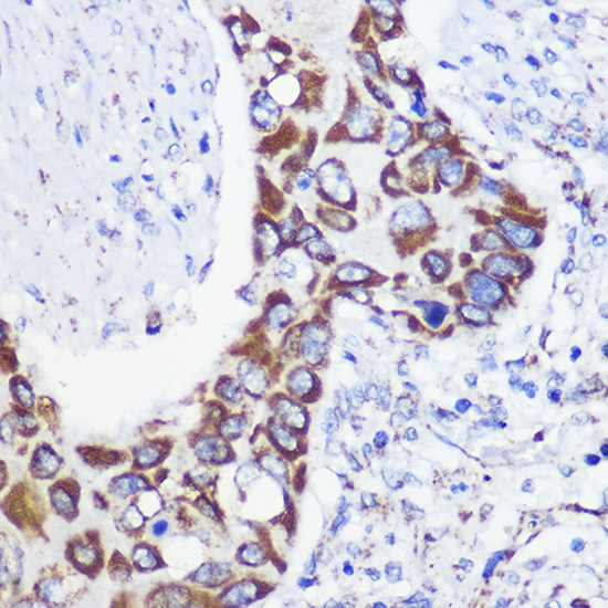 Immunohistochemistry of paraffin-embedded Human lung cancer using MTMR9 Rabbit pAb  at dilution of 1:100 