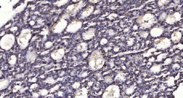 Immunohistochemical analysis of paraffin-embedded human liver cancer