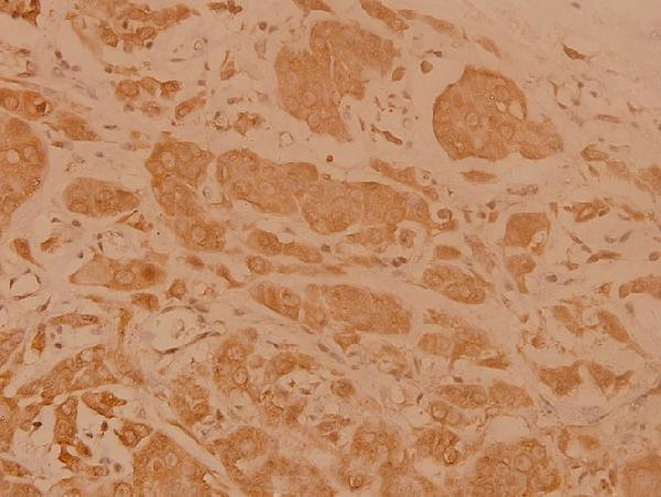 Immunohistochemistry (IHC) analyzes of Cerebral 1 (L310) pAb in paraffin-embedded human breast carcinoma tissue at 1:100