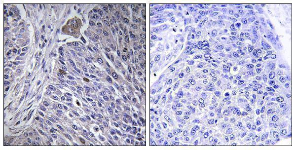 Immunohistochemistry analysis of paraffin-embedded human lung carcinoma tissue, using HNRPDL Antibody