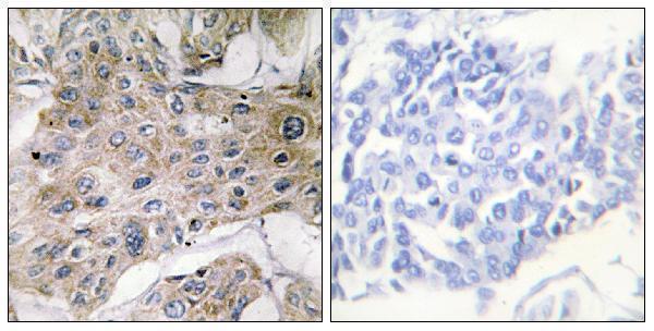 Immunohistochemistry analysis of paraffin-embedded human breast carcinoma tissue, using COX7S/A2 Antibody