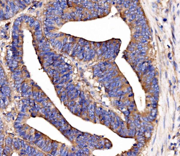 Figure 2. IHC analysis of SCRN1 using anti-SCRN1 antibody (A10002-1). SCRN1 was detected in a paraffin-embedded section of human rectal cancer tissue. Heat mediated antigen retrieval was performed in EDTA buffer (pH 8.0, epitope retrieval solution). The tissue section was blocked with 10% goat serum. The tissue section was then incubated with 2 microg/ml rabbit anti-SCRN1 Antibody (A10002-1) overnight at 4°C. Biotinylated goat anti-rabbit IgG was used as secondary antibody and incubated for 30 minutes at 37°C. The tissue section was developed using Strepavidin-Biotin-Complex (SABC) (Catalog # SA1022) with DAB as the chromogen.