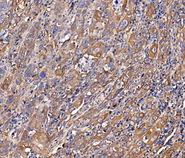 Figure 3. IHC analysis of SCRN1 using anti-SCRN1 antibody (A10002-1). SCRN1 was detected in a paraffin-embedded section of human gall bladder adenosquamous carcinoma tissue. Heat mediated antigen retrieval was performed in EDTA buffer (pH 8.0, epitope retrieval solution). The tissue section was blocked with 10% goat serum. The tissue section was then incubated with 2 microg/ml rabbit anti-SCRN1 Antibody (A10002-1) overnight at 4°C. Biotinylated goat anti-rabbit IgG was used as secondary antibody and incubated for 30 minutes at 37°C. The tissue section was developed using Strepavidin-Biotin-Complex (SABC) (Catalog # SA1022) with DAB as the chromogen.