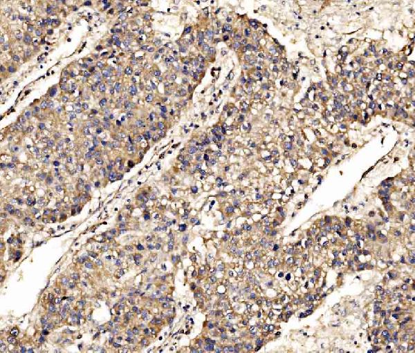 Figure 4. IHC analysis of SCRN1 using anti-SCRN1 antibody (A10002-1). SCRN1 was detected in a paraffin-embedded section of human liver cancer tissue. Heat mediated antigen retrieval was performed in EDTA buffer (pH 8.0, epitope retrieval solution). The tissue section was blocked with 10% goat serum. The tissue section was then incubated with 2 microg/ml rabbit anti-SCRN1 Antibody (A10002-1) overnight at 4°C. Biotinylated goat anti-rabbit IgG was used as secondary antibody and incubated for 30 minutes at 37°C. The tissue section was developed using Strepavidin-Biotin-Complex (SABC) (Catalog # SA1022) with DAB as the chromogen.