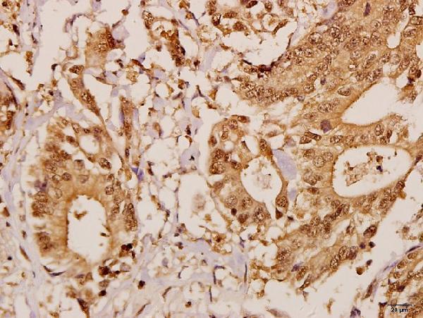 Immunohistochemistry (IHC) analyzes of GCP5 (I779) pAb in paraffin-embedded human colorectal carcinoma tissue at 1:50