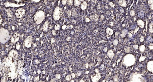 Immunohistochemical analysis of paraffin-embedded human liver cancer