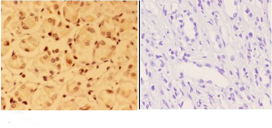 Immunohistochemistry (IHC) analyzes of ALX3 (R203) pAb in paraffin-embedded human kidney carcinoma tissue at 1:50,showing nucleus staining