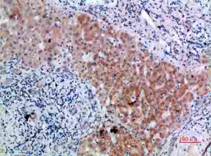 Immunohistochemical analysis of paraffin-embedded human-liver-cancer, antibody was diluted at 1:200