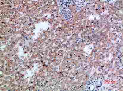 Immunohistochemical analysis of paraffin-embedded human-liver-cancer, antibody was diluted at 1:200