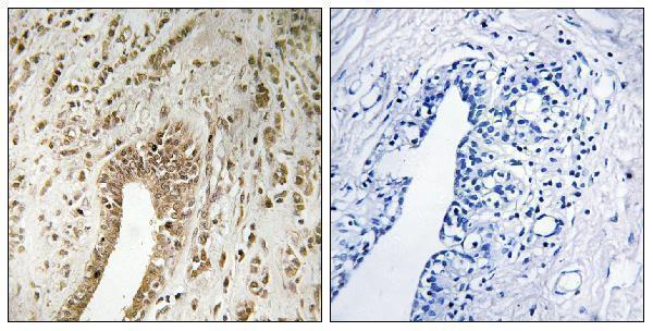 Immunohistochemistry analysis of paraffin-embedded human breast carcinoma tissue, using PHF3 Antibody