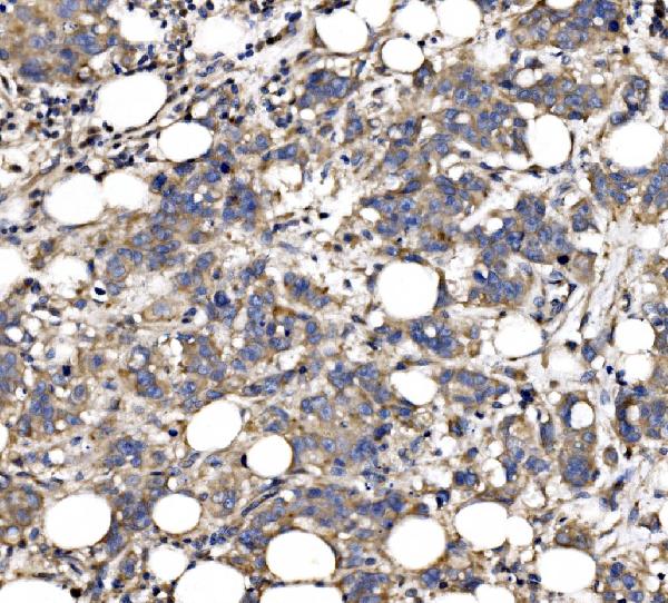 Figure 2. IHC analysis of QSOX2 using anti-QSOX2 antibody (A10205-1). QSOX2 was detected in a paraffin-embedded section of human breast cancer tissue. Heat mediated antigen retrieval was performed in EDTA buffer (pH 8.0, epitope retrieval solution). The tissue section was blocked with 10% goat serum. The tissue section was then incubated with 2 microg/ml rabbit anti-QSOX2 Antibody (A10205-1) overnight at 4°C. Biotinylated goat anti-rabbit IgG was used as secondary antibody and incubated for 30 minutes at 37°C. The tissue section was developed using Strepavidin-Biotin-Complex (SABC) (Catalog # SA1022) with DAB as the chromogen.