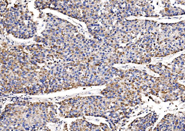 Figure 3. IHC analysis of QSOX2 using anti-QSOX2 antibody (A10205-1). QSOX2 was detected in a paraffin-embedded section of human liver cancer tissue. Heat mediated antigen retrieval was performed in EDTA buffer (pH 8.0, epitope retrieval solution). The tissue section was blocked with 10% goat serum. The tissue section was then incubated with 2 microg/ml rabbit anti-QSOX2 Antibody (A10205-1) overnight at 4°C. Biotinylated goat anti-rabbit IgG was used as secondary antibody and incubated for 30 minutes at 37°C. The tissue section was developed using Strepavidin-Biotin-Complex (SABC) (Catalog # SA1022) with DAB as the chromogen.