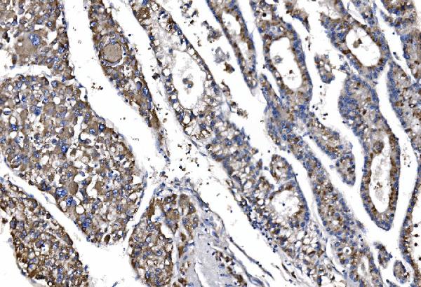 Figure 4. IHC analysis of QSOX2 using anti-QSOX2 antibody (A10205-1). QSOX2 was detected in a paraffin-embedded section of human liver cancer tissue. Heat mediated antigen retrieval was performed in EDTA buffer (pH 8.0, epitope retrieval solution). The tissue section was blocked with 10% goat serum. The tissue section was then incubated with 2 microg/ml rabbit anti-QSOX2 Antibody (A10205-1) overnight at 4°C. Biotinylated goat anti-rabbit IgG was used as secondary antibody and incubated for 30 minutes at 37°C. The tissue section was developed using Strepavidin-Biotin-Complex (SABC) (Catalog # SA1022) with DAB as the chromogen.