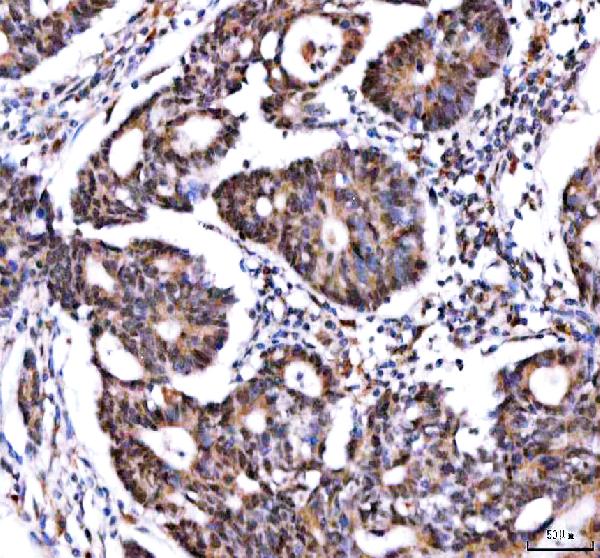 Figure 2. IHC analysis of IPO9 using anti-IPO9 antibody (A10216-2). IPO9 was detected in a paraffin-embedded section of human colon adenocarcinoma tissue. Heat mediated antigen retrieval was performed in EDTA buffer (pH 8.0, epitope retrieval solution). The tissue section was blocked with 10% goat serum. The tissue section was then incubated with 2 microg/ml rabbit anti-IPO9 Antibody (A10216-2) overnight at 4°C. Peroxidase Conjugated Goat Anti-rabbit IgG was used as secondary antibody and incubated for 30 minutes at 37°C. The tissue section was developed using HRP Conjugated Rabbit IgG Super Vision Assay Kit (Catalog # SV0002) with DAB as the chromogen. Figure 2. IHC analysis of IPO9 using anti-IPO9 antibody (A10216-2). IPO9 was detected in a paraffin-embedded section of human colon adenocarcinoma tissue. Heat mediated antigen retrieval was performed in EDTA buffer (pH 8.0, epitope retrieval solution). The tissue section was blocked with 10% goat serum. The tissue section was then incubated with 2 microg/ml rabbit anti-IPO9 Antibody (A10216-2) overnight at 4°C. Peroxidase Conjugated Goat Anti-rabbit IgG was used as secondary antibody and incubated for 30 minutes at 37°C. The tissue section was developed using HRP Conjugated Rabbit IgG Super Vision Assay Kit (Catalog # SV0002) with DAB as the chromogen.