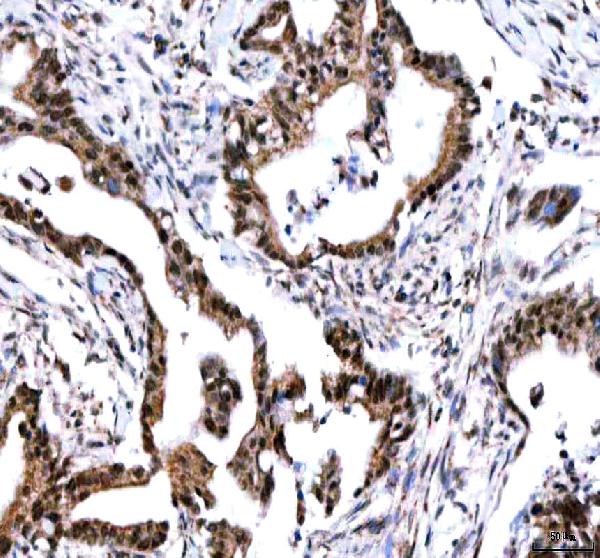 Figure 4. IHC analysis of IPO9 using anti-IPO9 antibody (A10216-2). IPO9 was detected in a paraffin-embedded section of human pancreas ductal adenocarcinoma tissue. Heat mediated antigen retrieval was performed in EDTA buffer (pH 8.0, epitope retrieval solution). The tissue section was blocked with 10% goat serum. The tissue section was then incubated with 2 microg/ml rabbit anti-IPO9 Antibody (A10216-2) overnight at 4°C. Peroxidase Conjugated Goat Anti-rabbit IgG was used as secondary antibody and incubated for 30 minutes at 37°C. The tissue section was developed using HRP Conjugated Rabbit IgG Super Vision Assay Kit (Catalog # SV0002) with DAB as the chromogen. Figure 4. IHC analysis of IPO9 using anti-IPO9 antibody (A10216-2). IPO9 was detected in a paraffin-embedded section of human pancreas ductal adenocarcinoma tissue. Heat mediated antigen retrieval was performed in EDTA buffer (pH 8.0, epitope retrieval solution). The tissue section was blocked with 10% goat serum. The tissue section was then incubated with 2 microg/ml rabbit anti-IPO9 Antibody (A10216-2) overnight at 4°C. Peroxidase Conjugated Goat Anti-rabbit IgG was used as secondary antibody and incubated for 30 minutes at 37°C. The tissue section was developed using HRP Conjugated Rabbit IgG Super Vision Assay Kit (Catalog # SV0002) with DAB as the chromogen.