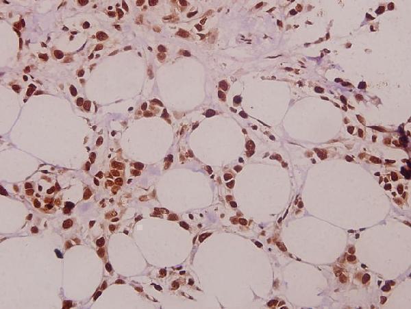 Immunohistochemistry (IHC) analyzes of SFRS15 (V641) pAb in paraffin-embedded human colorectal carcinoma tissue at 1:50