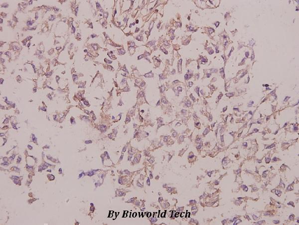 Immunohistochemistry (IHC) analyzes of Laminin γ-3 (T1385) pAb in paraffin-embedded human breast carcinoma tissue at 1:50