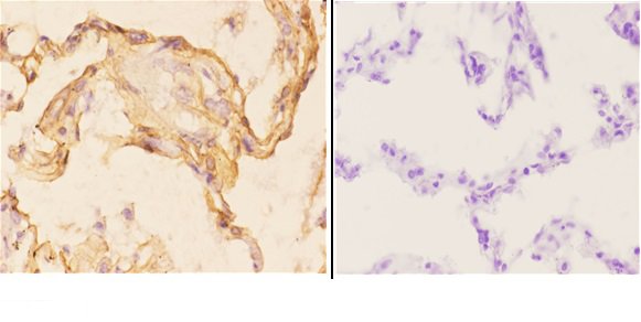 Immunohistochemistry (IHC) analyzes of MRP-S22 (R263) pAb in paraffin-embedded human lung carcinoma tissue at 1:50