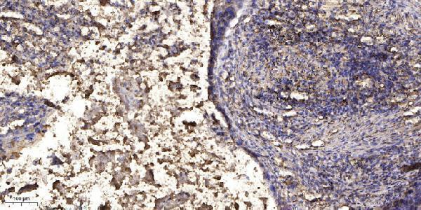 Immunohistochemical analysis of paraffin-embedded human Squamous cell carcinoma of lung