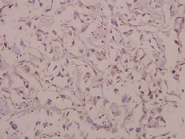 Immunohistochemistry (IHC) analyzes of Cadherin-7 (R678) pAb in paraffin-embedded human colorectal carcinoma tissue at 1:50