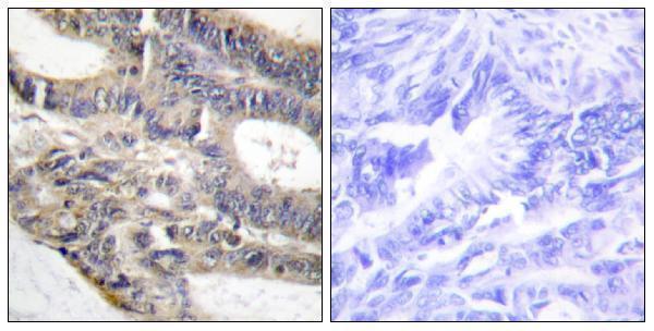 Immunohistochemistry analysis of paraffin-embedded human colon carcinoma tissue, using AS250 Antibody