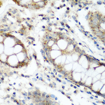 Immunohistochemistry of paraffin-embedded human liver cancer using NAA60 antibody  at dilution of 1:200 