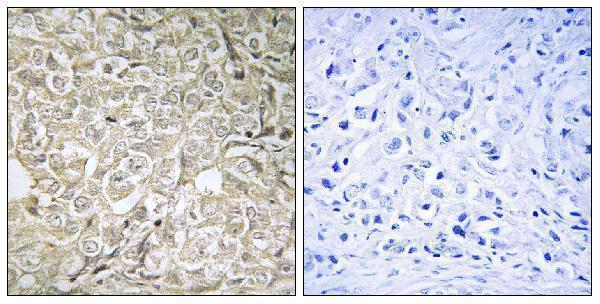 Immunohistochemistry analysis of paraffin-embedded human prostate carcinoma tissue, using RAB37 Antibody