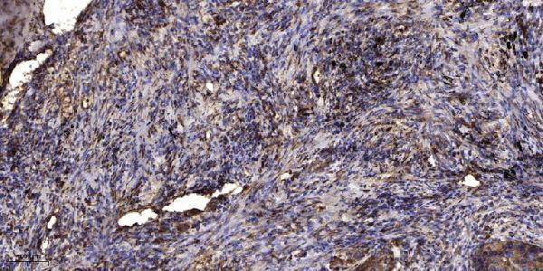 Immunohistochemical analysis of paraffin-embedded human Squamous cell carcinoma of lung