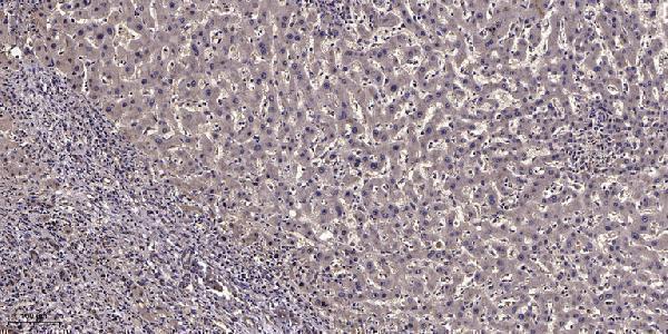 Immunohistochemical analysis of paraffin-embedded human liver cancer