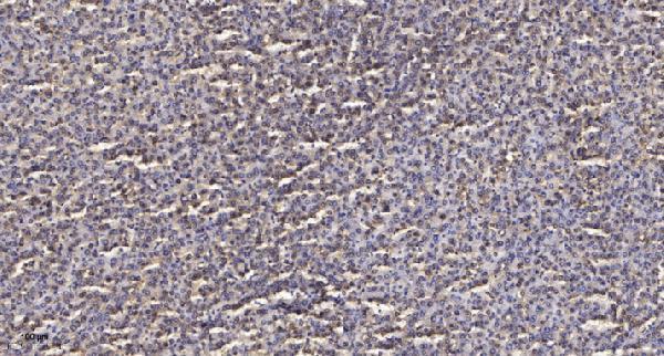 Immunohistochemical analysis of paraffin-embedded human liver cancer
