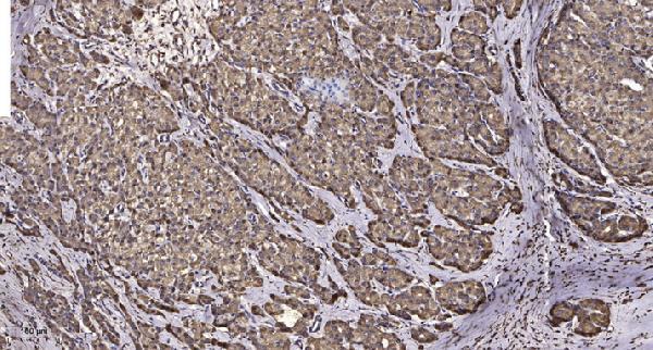 Immunohistochemical analysis of paraffin-embedded human liver cancer