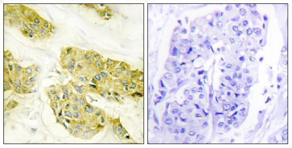 Immunohistochemistry analysis of paraffin-embedded human breast carcinoma tissue, using Collagen V alpha3 Antibody